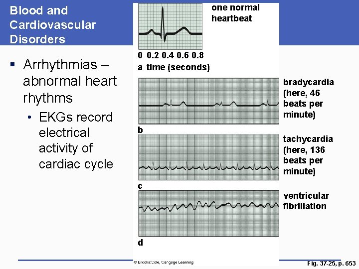 one normal heartbeat Blood and Cardiovascular Disorders § Arrhythmias – abnormal heart rhythms •