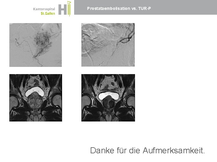 Prostataembolisation vs. TUR-P Danke für die Aufmerksamkeit. 