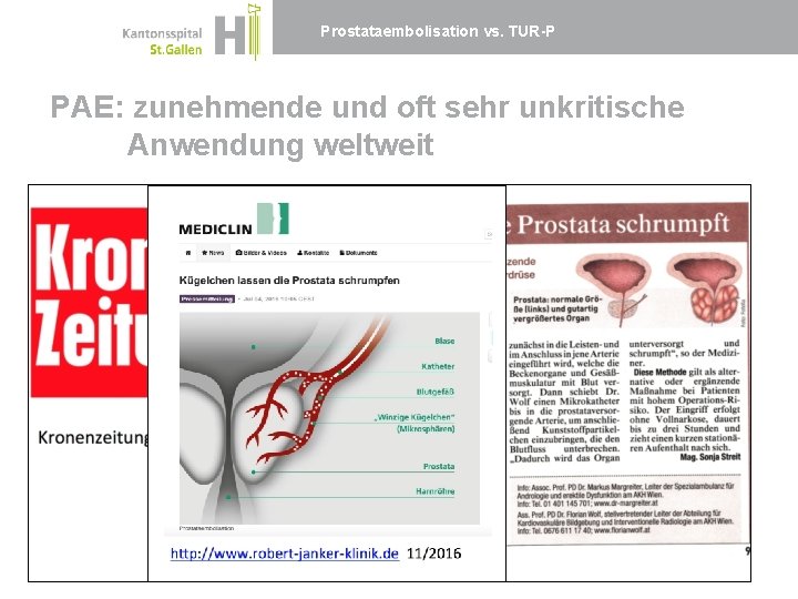 Prostataembolisation vs. TUR-P PAE: zunehmende und oft sehr unkritische Anwendung weltweit 