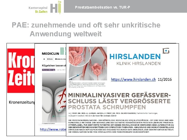 Prostataembolisation vs. TUR-P PAE: zunehmende und oft sehr unkritische Anwendung weltweit 