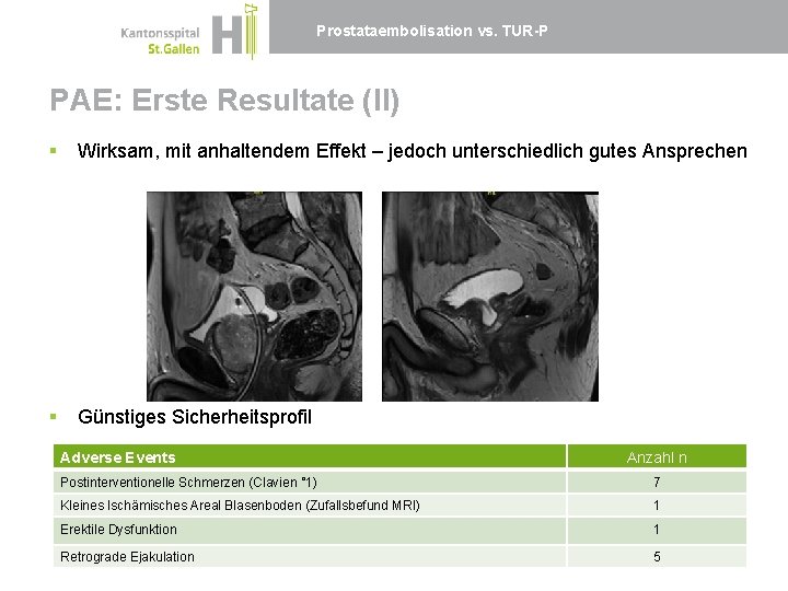 Prostataembolisation vs. TUR-P PAE: Erste Resultate (II) § Wirksam, mit anhaltendem Effekt – jedoch