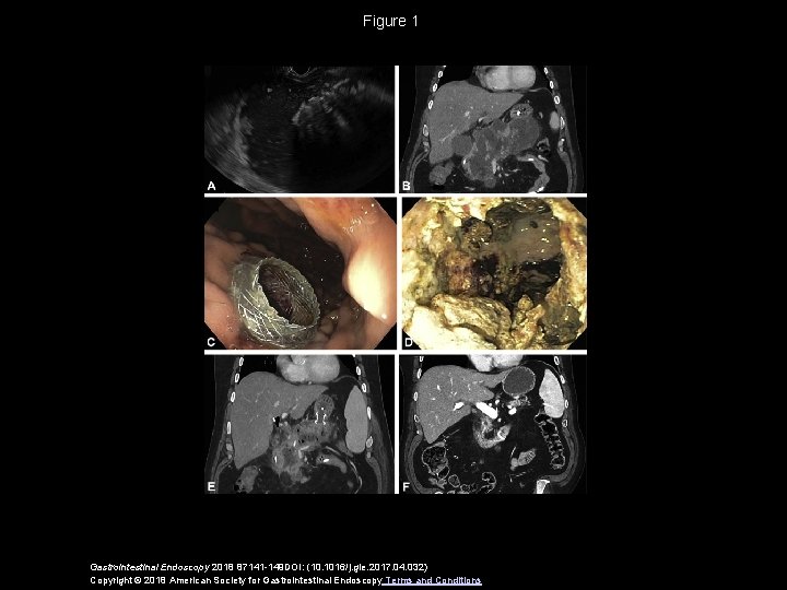 Figure 1 Gastrointestinal Endoscopy 2018 87141 -149 DOI: (10. 1016/j. gie. 2017. 04. 032)