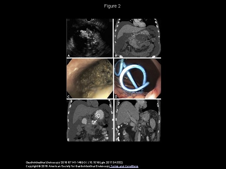 Figure 2 Gastrointestinal Endoscopy 2018 87141 -149 DOI: (10. 1016/j. gie. 2017. 04. 032)