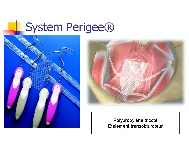 System Perigee® Polypropylène tricoté Etalement transobturateur 