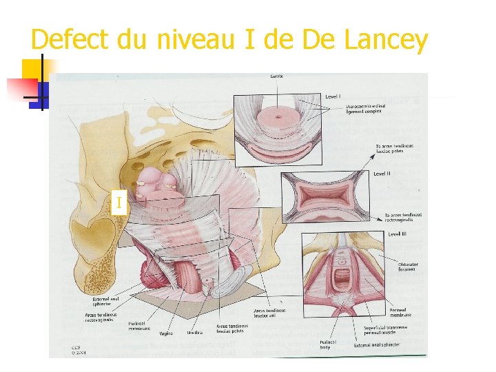 Defect du niveau I de De Lancey I 