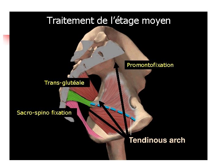 Traitement de l’étage moyen Promontofixation Trans-glutéale Sacro-spino fixation 