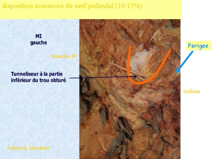 disposition accessoire du nerf pudendal (10 -15%) Perigee branche IP ischion Spinosa, lausanne 