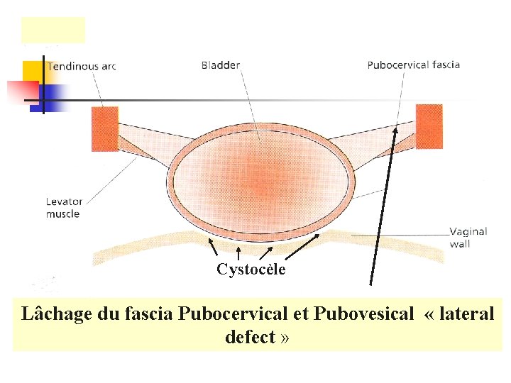 Cystocèle Lâchage du fascia Pubocervical et Pubovesical « lateral defect » 