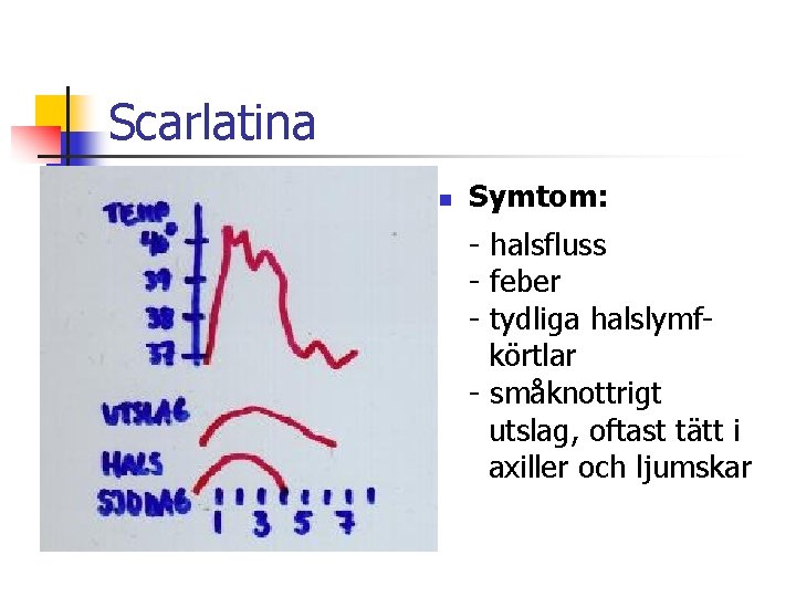 Scarlatina n Symtom: - halsfluss - feber - tydliga halslymfkörtlar - småknottrigt utslag, oftast