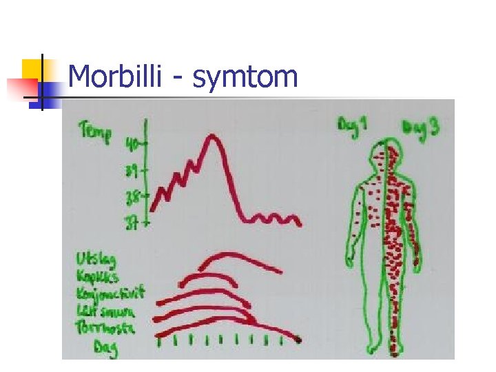 Morbilli - symtom 