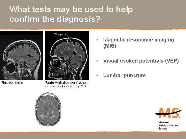 What tests may be used to help confirm the diagnosis? • Magnetic resonance imaging