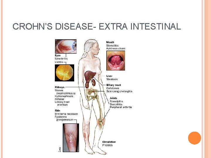 CROHN’S DISEASE- EXTRA INTESTINAL 