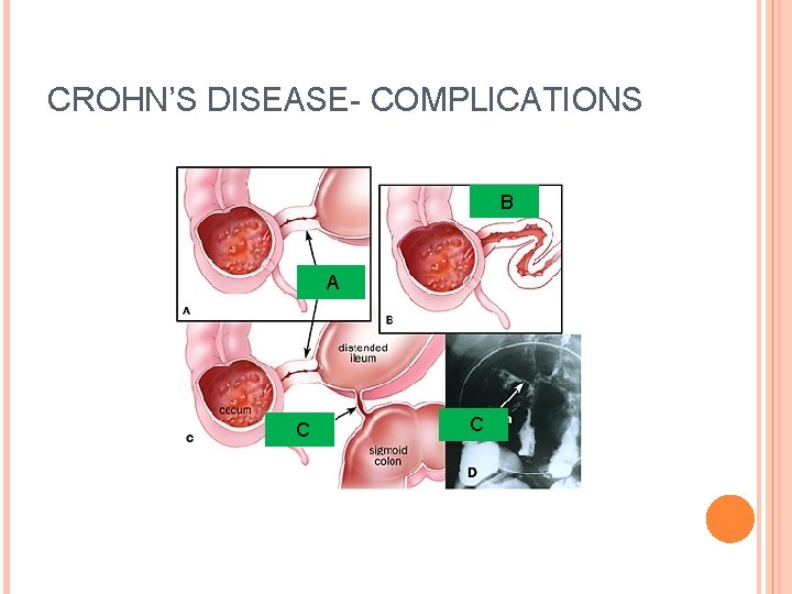 CROHN’S DISEASE- COMPLICATIONS B A C C 