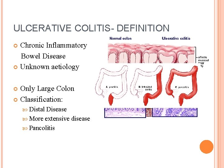 ULCERATIVE COLITIS- DEFINITION Chronic Inflammatory Bowel Disease Unknown aetiology Only Large Colon Classification: Distal