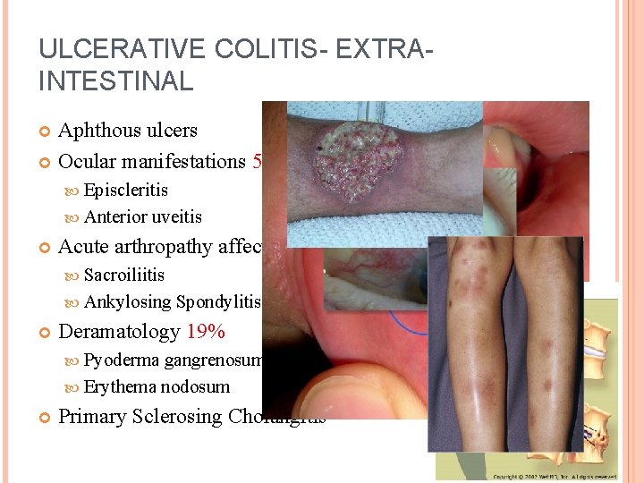 ULCERATIVE COLITIS- EXTRAINTESTINAL Aphthous ulcers Ocular manifestations 5% Episcleritis Anterior uveitis Acute arthropathy affecting