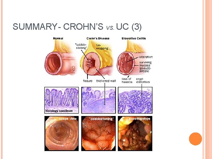 SUMMARY- CROHN’S VS. UC (3) 