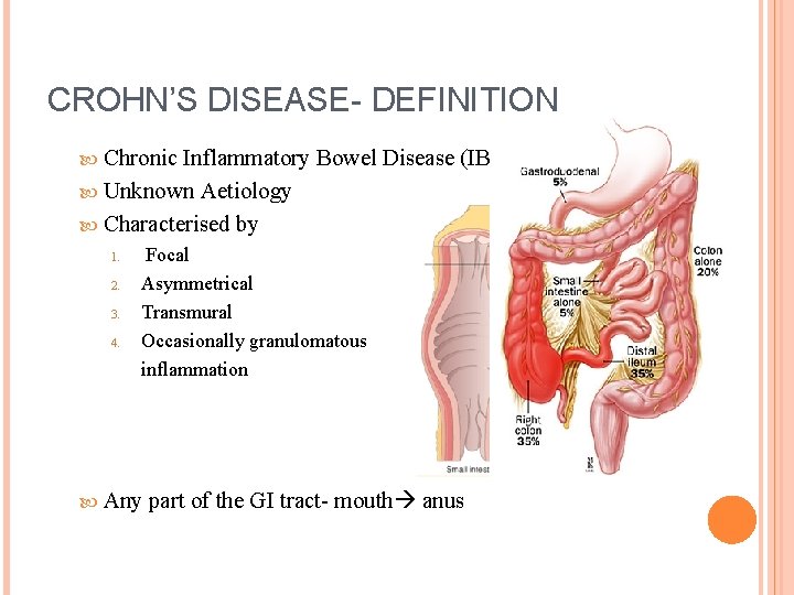 CROHN’S DISEASE- DEFINITION Chronic Inflammatory Bowel Disease (IBD) Unknown Aetiology Characterised by 1. 2.