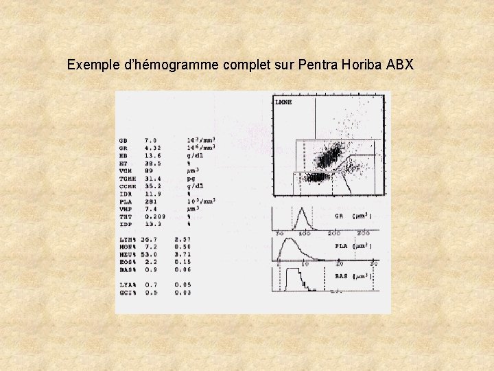 Exemple d’hémogramme complet sur Pentra Horiba ABX Exemple d’hémogramme complet sur Pentra Horiba ABX
