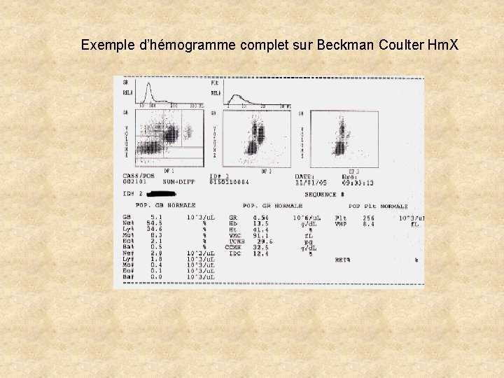 Exemple d’hémogramme complet sur Beckman Coulter Hm. X Exemple d’hémogramme complet sur Beckman Coulter Hm. X