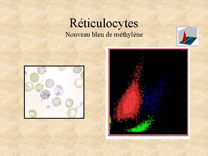 Réticulocytes Nouveau bleu de méthylène Réticulocytes Nouveau bleu de méthylène