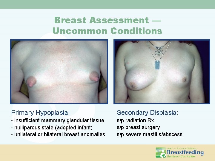 Breast Assessment — Uncommon Conditions Primary Hypoplasia: Secondary Displasia: - insufficient mammary glandular tissue