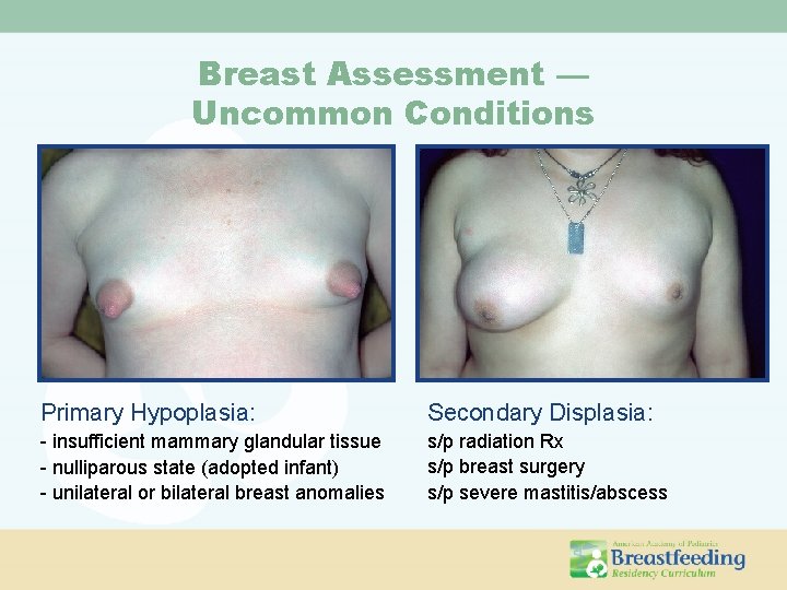 Breast Assessment — Uncommon Conditions Primary Hypoplasia: Secondary Displasia: - insufficient mammary glandular tissue Breast Assessment — Uncommon Conditions Primary Hypoplasia: Secondary Displasia: - insufficient mammary glandular tissue