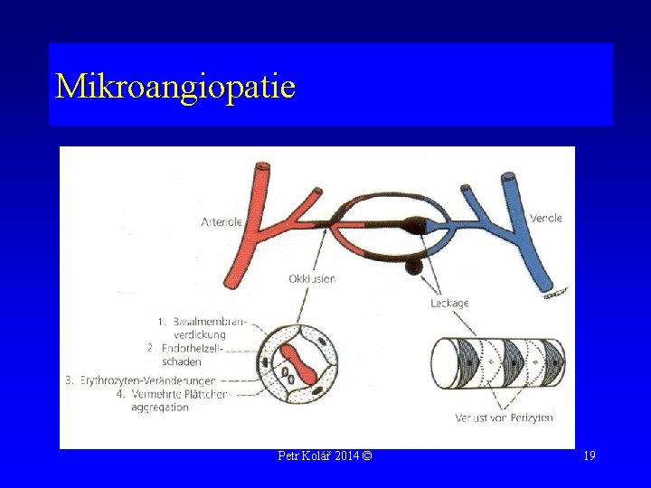 Mikroangiopatie Petr Kolář 2014 © 19 