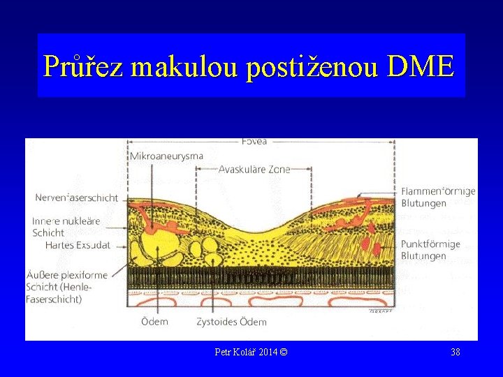 Průřez makulou postiženou DME Petr Kolář 2014 © 38 