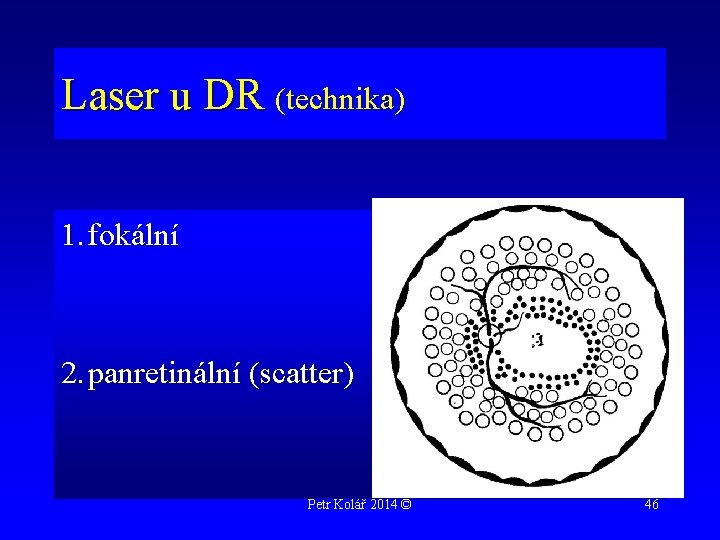 Laser u DR (technika) 1. fokální 2. panretinální (scatter) Petr Kolář 2014 © 46