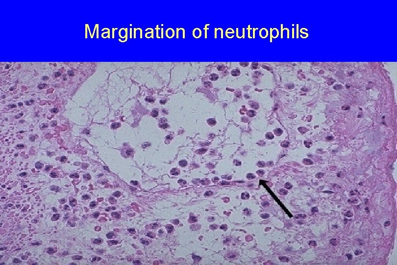 Margination of neutrophils 