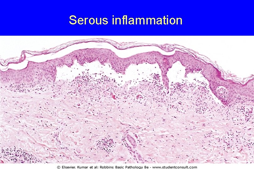 Serous inflammation 