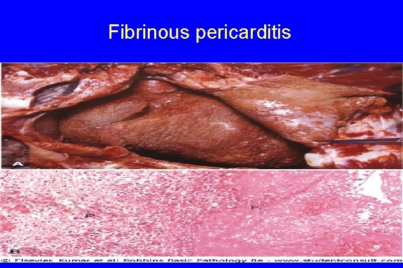 Fibrinous pericarditis 