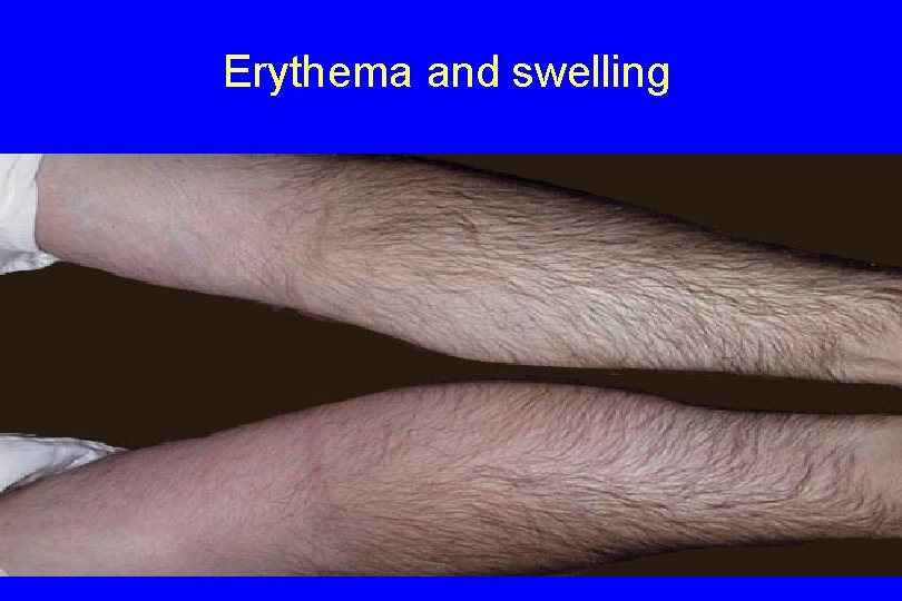 Erythema and swelling 
