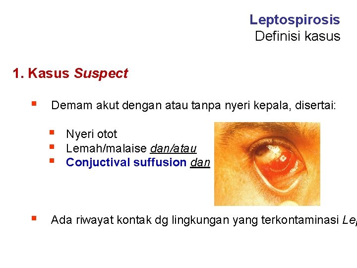 Leptospirosis Definisi kasus 1. Kasus Suspect § Demam akut dengan atau tanpa nyeri kepala,