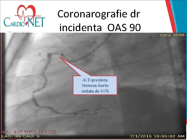 Coronarografie dr incidenta OAS 90 ACD prezinta Stenoza Aorto ostiala de 60% 