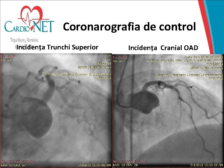 Coronarografia de control Incidența Trunchi Superior Incidența Cranial OAD 