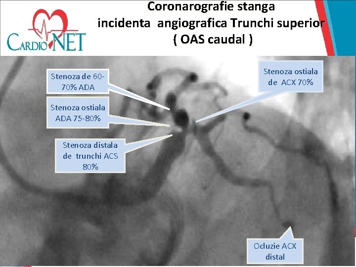 Coronarografie stanga incidenta angiografica Trunchi superior ( OAS caudal ) Stenoza de 6070% ADA