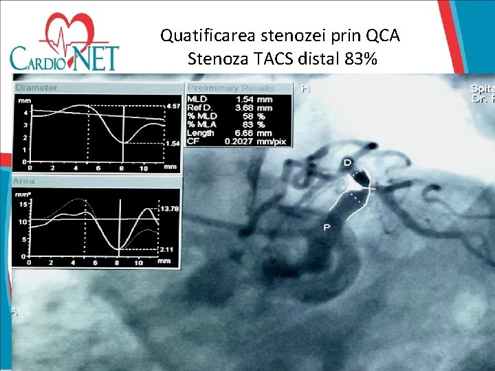 Quatificarea stenozei prin QCA Stenoza TACS distal 83% 