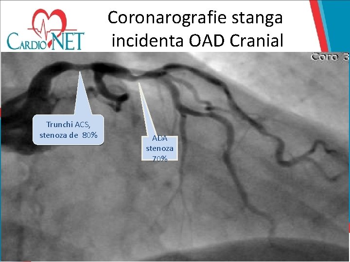 Coronarografie stanga incidenta OAD Cranial Trunchi ACS, stenoza de 80% ADA stenoza 70% 