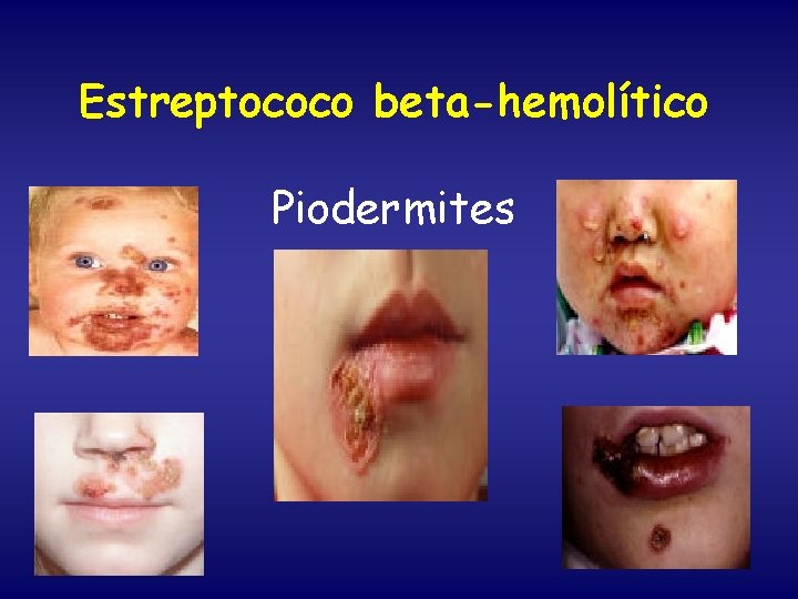 Estreptococo beta-hemolítico Piodermites 