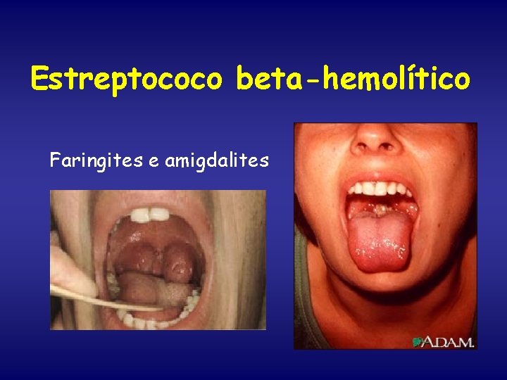 Estreptococo beta-hemolítico Faringites e amigdalites 