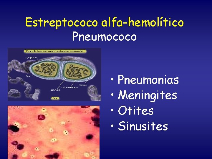 Estreptococo alfa-hemolítico Pneumococo • Pneumonias • Meningites • Otites • Sinusites 