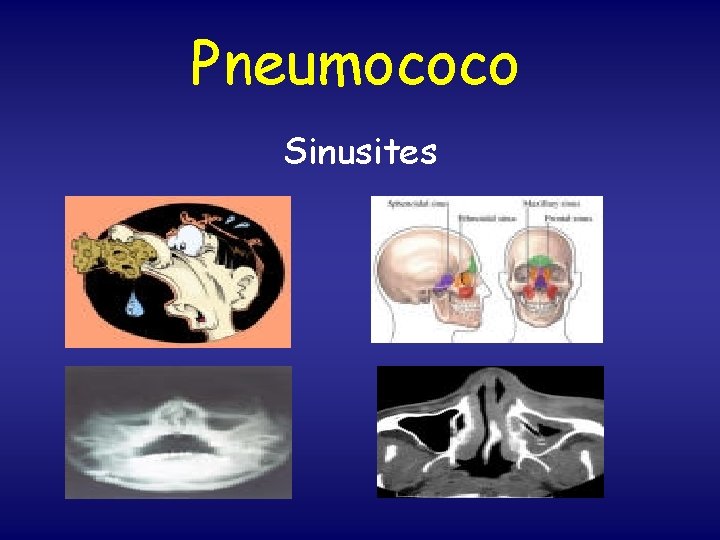 Pneumococo Sinusites 