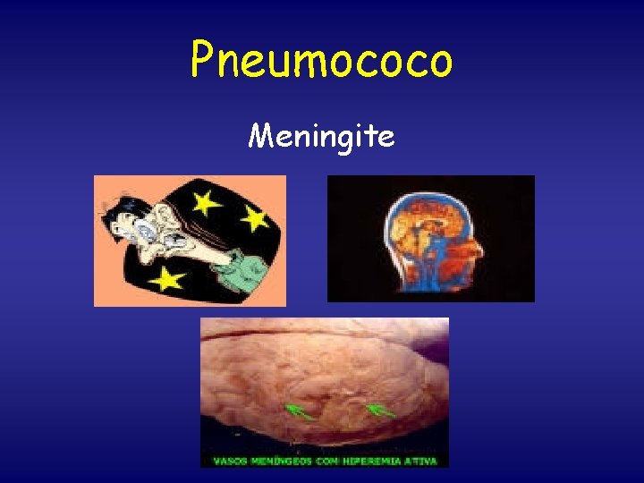 Pneumococo Meningite 