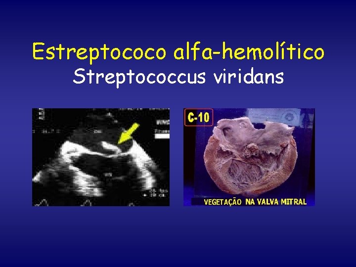 Estreptococo alfa-hemolítico Streptococcus viridans 
