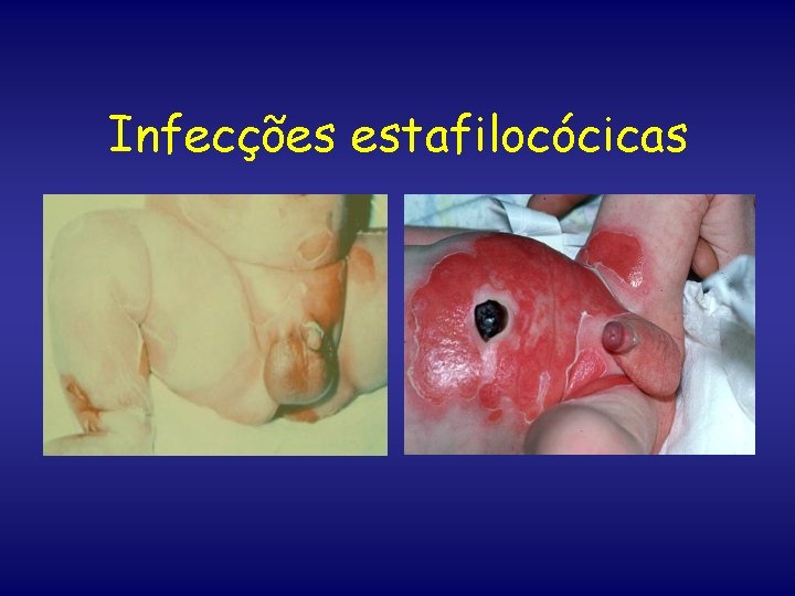 Infecções estafilocócicas 