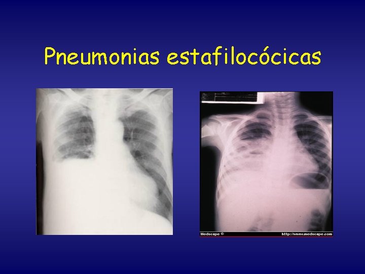 Pneumonias estafilocócicas 