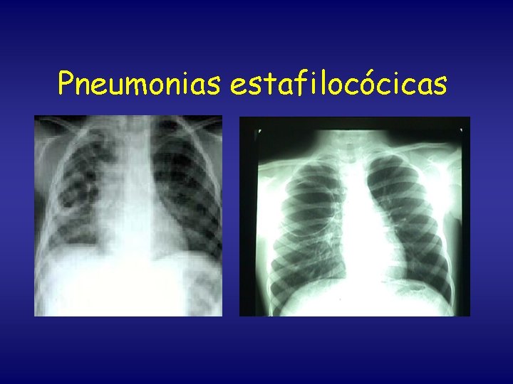 Pneumonias estafilocócicas 