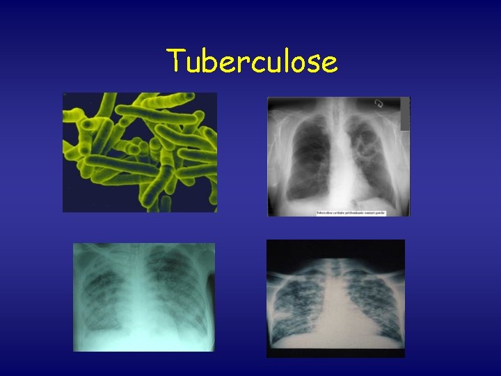 Tuberculose 