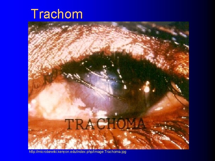 Trachom http: //microbewiki. kenyon. edu/index. php/Image: Trachoma. jpg 